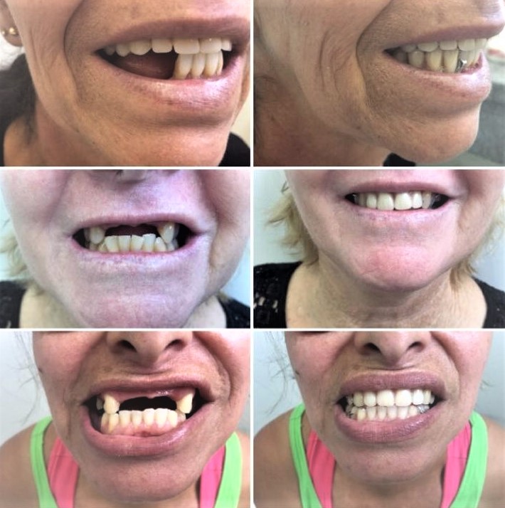 Antes e depois de pacientes odontológicos de Urupês - Foto: divulgação